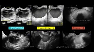 Hemorrhagic vs Endometriotic vs Dermoid cyst Recap series V2 [upl. by Sirdna]