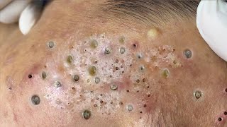 Big Cystic Acne Blackheads Extraction Blackheads amp Milia Whiteheads Removal Pimple Popping  1207 [upl. by Nosmoht]