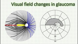 Visual field changes in glaucoma [upl. by Seditsira]