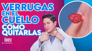 VERRUGAS EN EL CUELLO COMO QUITARLAS Tips de un dermatologo [upl. by Ennovehc]