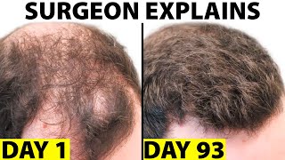 Oral Minoxidil  A Better Hair Loss Treatment [upl. by Novick949]