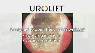 UroLift™ System Treatment [upl. by Kask310]