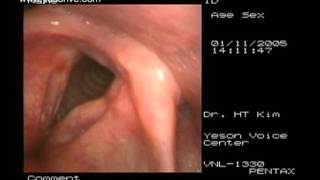 Laryngoplasty of sulcus vocalis [upl. by Aharon]