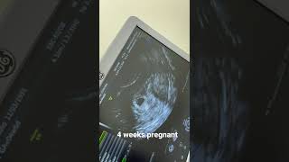 4 weeks pregnant Ultrasound in 4 weeks What you can see [upl. by Pani]