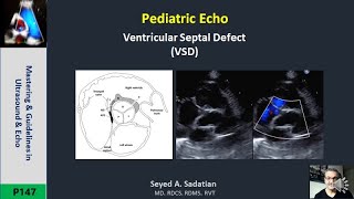 Pediatric Echo Ventricular Septal Defect VSD [upl. by Aldo804]