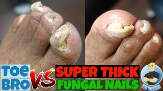 Trimming of Super Thick Fungal Nails FULL TREATMENT [upl. by Traweek]