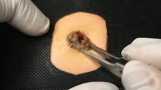 BEST Pimple Popping  Whiteheads Removal  Big Cystic Acne Blackheads  Squeezing Pimples  Tr0039 [upl. by Zuzana]