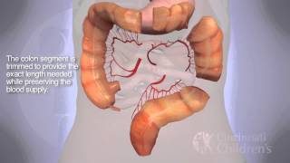 Segmental Colonic Interposition for Esophageal Atresia 3D Animation [upl. by Eveineg]