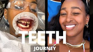 MY TEETH JOURNEY  I GOT PORCELAIN VENEERS  BEFORE AND AFTER PHOTOS  DR NEAL PATEL  THE YUSUFS [upl. by Leonore]