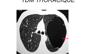 PNEUMOLOGIE broncho pneumopathie chronique obstructive 2015 [upl. by Oivalf]