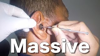 Removing Officers Massive Impacted Earwax without Earwax Softener [upl. by Bodwell]