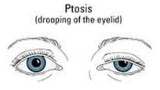 Ptosis MY Before amp After [upl. by Hartmunn]