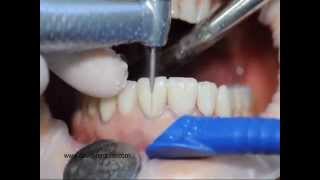 Procera veneers removal [upl. by Lister]