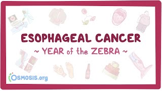 Esophageal Cancer Year of the Zebra [upl. by Quintessa]