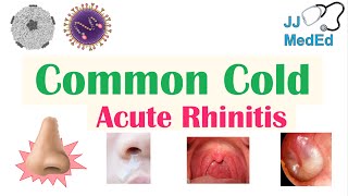 Common Cold Acute Rhinitis  Causes ex Coronaviruses Risk Factors Transmission Symptoms [upl. by Sayre]