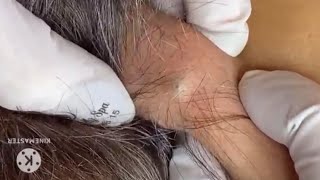 BIG ACNE 😱 Remoção de acnes e cravos vídeosatisfatorio satisfactory relaxing [upl. by Atinod]