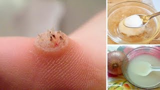 How to Get Rid of Warts Naturally [upl. by Meyer]