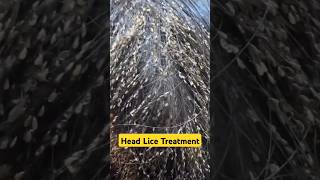 Get rid of Head LICE and EGGS headliceremoval headlice shorts dadumedicalcentre [upl. by Ahsinroc]