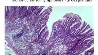 GASTROENTEROLOGIE anapathG Les Gastrites chroniques externes 2016 [upl. by Trudnak941]