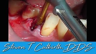 Immediate Implant Placement Following Extraction  Dental Minute with Steven T Cutbirth DDS [upl. by Merriman354]