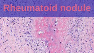 What are Rheumatoid Nodules  Pathology mini tutorials [upl. by Savanna]