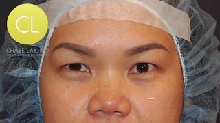 ChaseLayMD Asian Eyelid Surgery Deep Vietnamese Eyes [upl. by Kaplan]