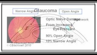 Glaucoma 3 Narrow Angle [upl. by Nevah]