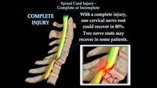 Spinal Cord Injury Complete Or Incomplete  Everything You Need To Know  Dr Nabil Ebraheim [upl. by Ury]