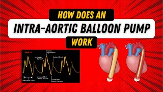 How Does an Intra Aortic Balloon Pump Work Guide for Nurses [upl. by Ignazio]