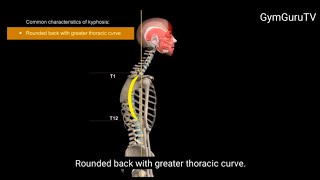 Common characteristics of kyphosis GymGuruTV [upl. by Terra838]