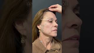 ELIMINANDO RUGAS EM 25 DIAS harmonizacaofacial rejuvenescimentofacial cuidadoscomapele hof [upl. by Smaoht]