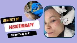 Mesotherapy  Notice facial wrinkles and hair loss when you are 40 [upl. by Ollayos]