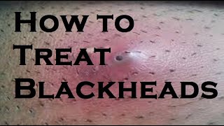 How to treat blackheads [upl. by Akinehs988]