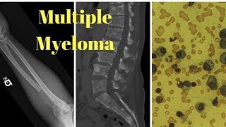 Outlook for People with Multiple Myeloma [upl. by Mindi]