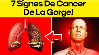 7 Signes Et Symptômes De Cancer De La Gorge [upl. by Kennie]