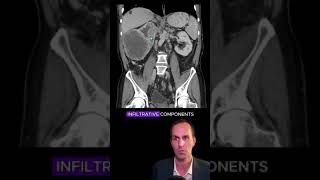 Renal cell carcinoma CT interpretation radiology medicalstudent radiologist radiographer [upl. by Lauber]