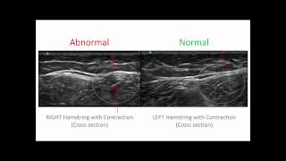 Hamstrings Injury Diagnosis [upl. by Brenk327]