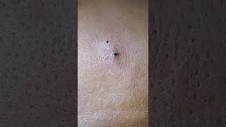 Another huge back Blackhead Squeeze [upl. by Glanti]