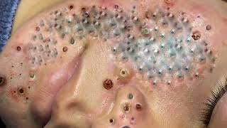 Big Cystic Acne Blackheads Extraction Blackheads amp Milia Whiteheads Removal Pimple Popping 0176 [upl. by Forsyth]