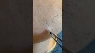 Sit Back and Relax Beard Removal with Tweezers hairremoval plucking ingrownhair satisfying [upl. by Atoked]