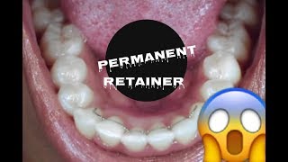 HOW TO CLEAN A PERMANENT RETAINER AFTER BRACES [upl. by Gratia]