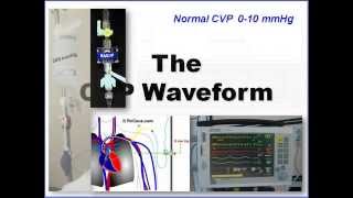 CVP and Arterial Line Waveform Interpretation [upl. by Lamek767]