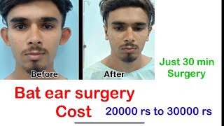 Bat ear surgery chennai hyderabad kochi Trivendrum madurai Coimbatore Visakhapatnam  Projected ear [upl. by Scarrow]