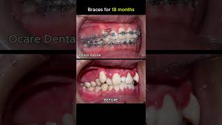 18 months braces process [upl. by Ennaecarg]