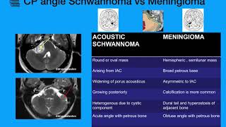 CP Angle tumors Schwannoma Meningioma [upl. by De]