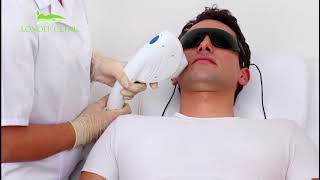 Depilazione Laser Londei Clinic [upl. by Erich]