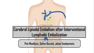 Cerebral Lipiodol Embolism after Interventional Lymphatic Embolization [upl. by Pallaten]