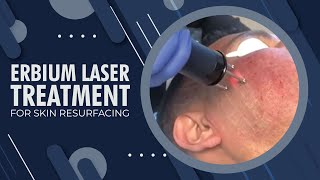 Erbium Laser Treatment for Skin Resurfacing  Beverly Hills CA [upl. by Thilde]