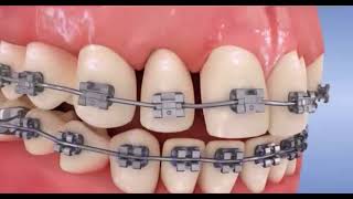 Orthodontie  Comment resserrer ses dents avec des bagues [upl. by Sardella]