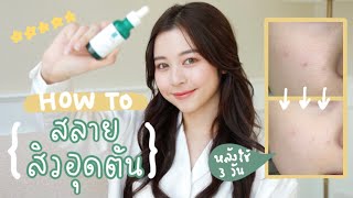 REVIEW สลายสิวอุดตันให้หายเกลี้ยง ปังมากก wLa RochePosay Effaclar Serum ตัวใหม่  Babyjingko [upl. by Marcello]